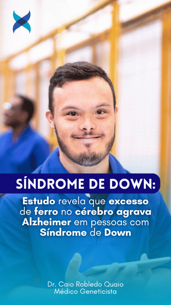 Estudo revela que excesso de ferro no cérebro agrava Alzheimer em pessoas com Síndrome de Down