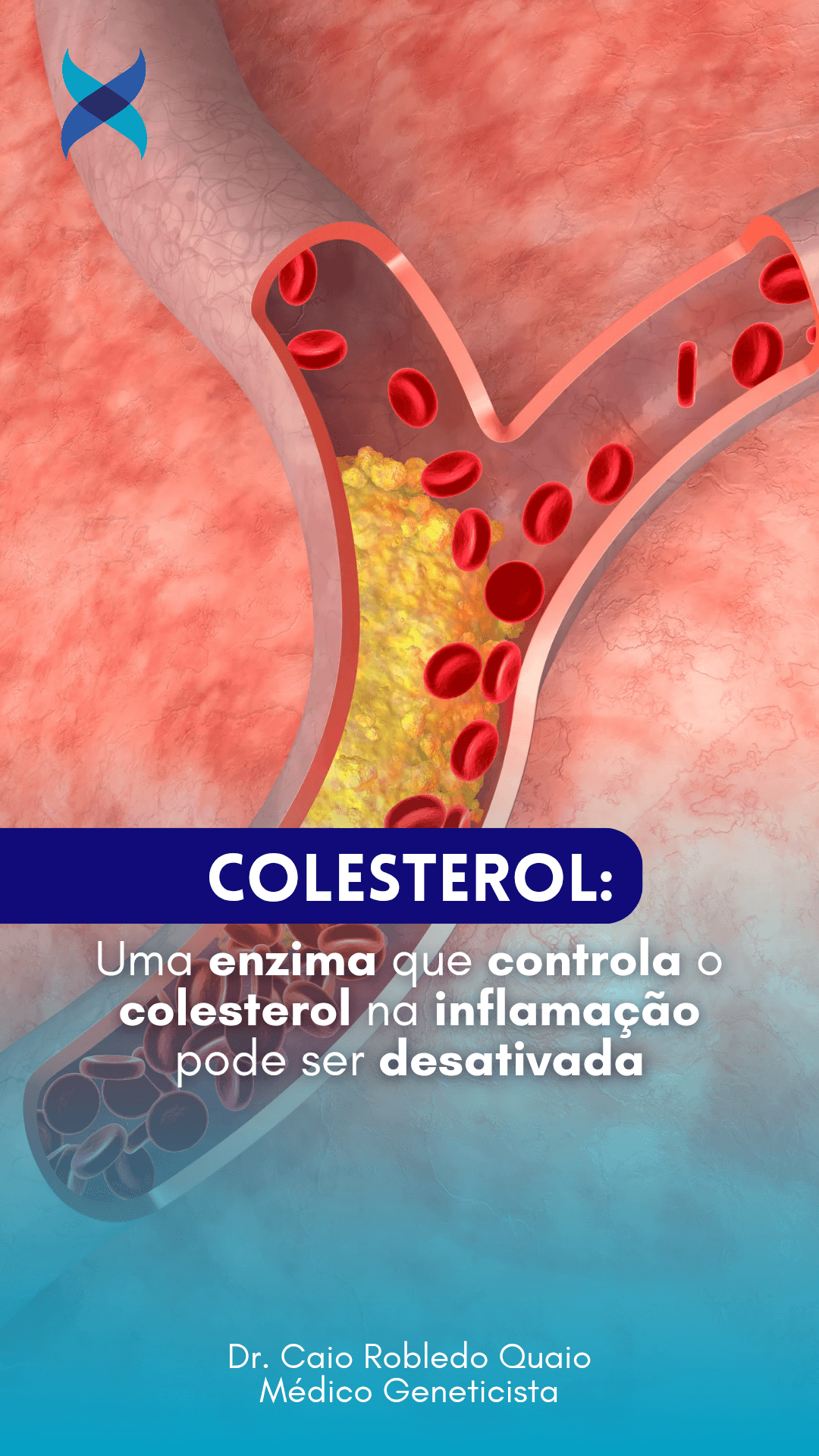 Uma enzima que controla o colesterol na inflamação pode ser desativada Pesquisadores descobriram uma nova enzima que, ao ser bloqueada, pode restaurar a capacidade do corpo de manter os níveis saudáveis de colesterol, um avanço com grande potencial para o tratamento de doenças cardíacas, diabetes, câncer e demência. O estudo revela que a enzima IDO1, ativada em situações inflamatórias, produz uma substância chamada quinurenina, que prejudica a função dos macrófagos, células imunes fundamentais na absorção e transporte do colesterol. Com IDO1 ativa, os macrófagos perdem a habilidade de lidar com o colesterol, favorecendo o acúmulo de placas nas artérias e o desenvolvimento de doenças crônicas.