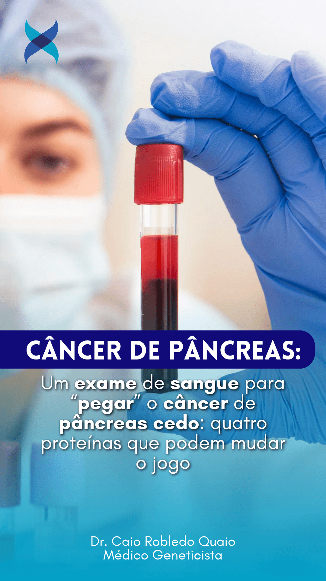 exame de sangue para câncer de pâncreas com painel de quatro proteínas.