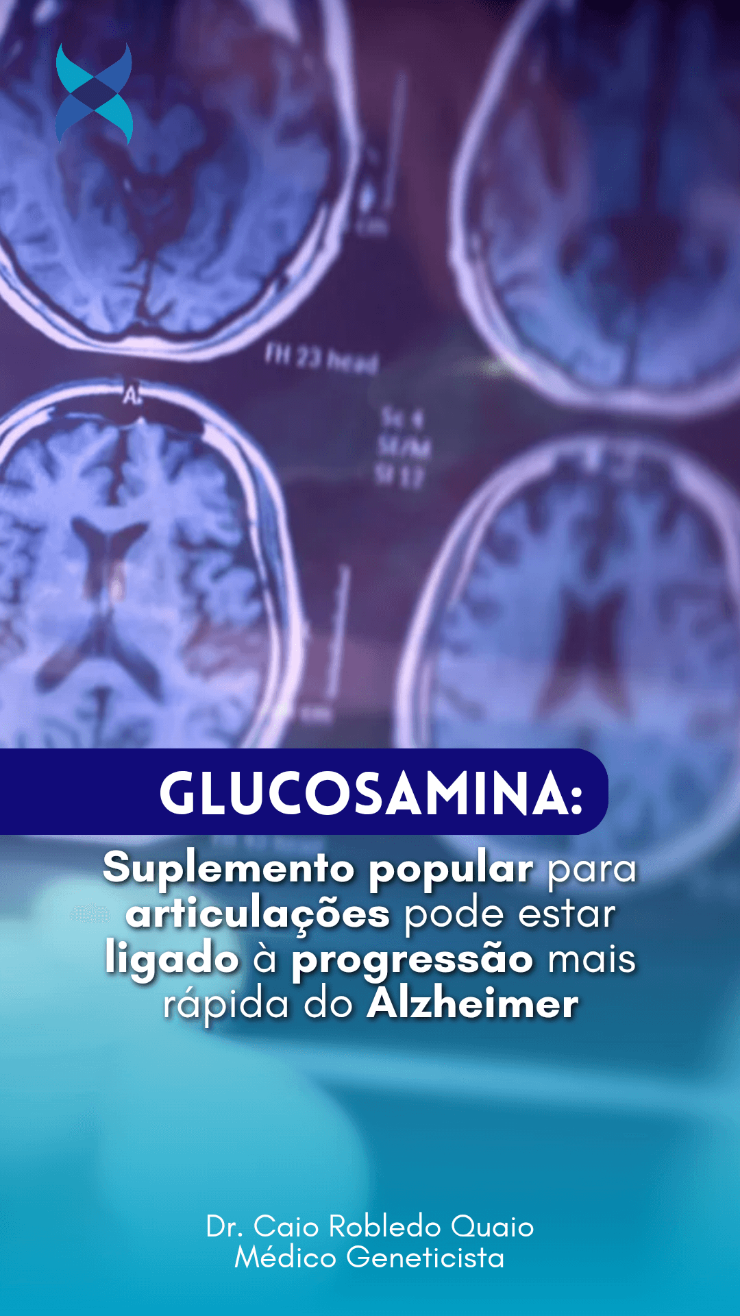 glucosamina Alzheimer e possível relação com progressão da demência