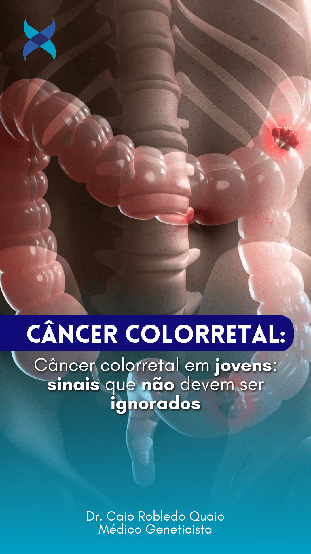 Câncer colorretal em jovens e principais sinais de alerta